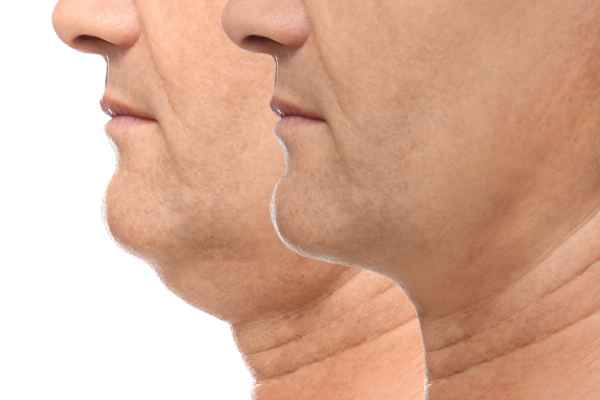 HIFU - Breakthrough in Anti - ageing 2 hifu results Ashtead