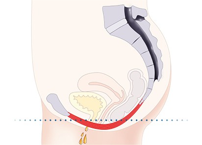 Pelvic-Floor Muscle Repair 5 Pelvic floor muscles Ashtead