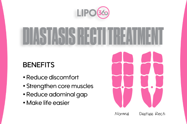 Revolutionising Muscle Repair: The Power of LIPO360 Body Sculpt Post-Injury 5 diastasis recti treatment Ashtead