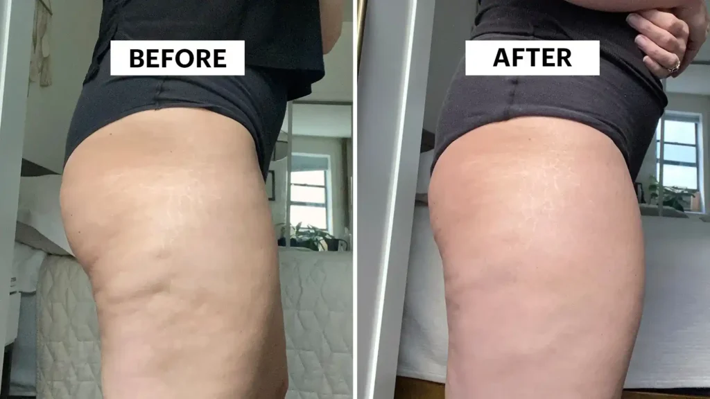 Do Toning Exercise Ashtead Really Tackle Cellulite?
