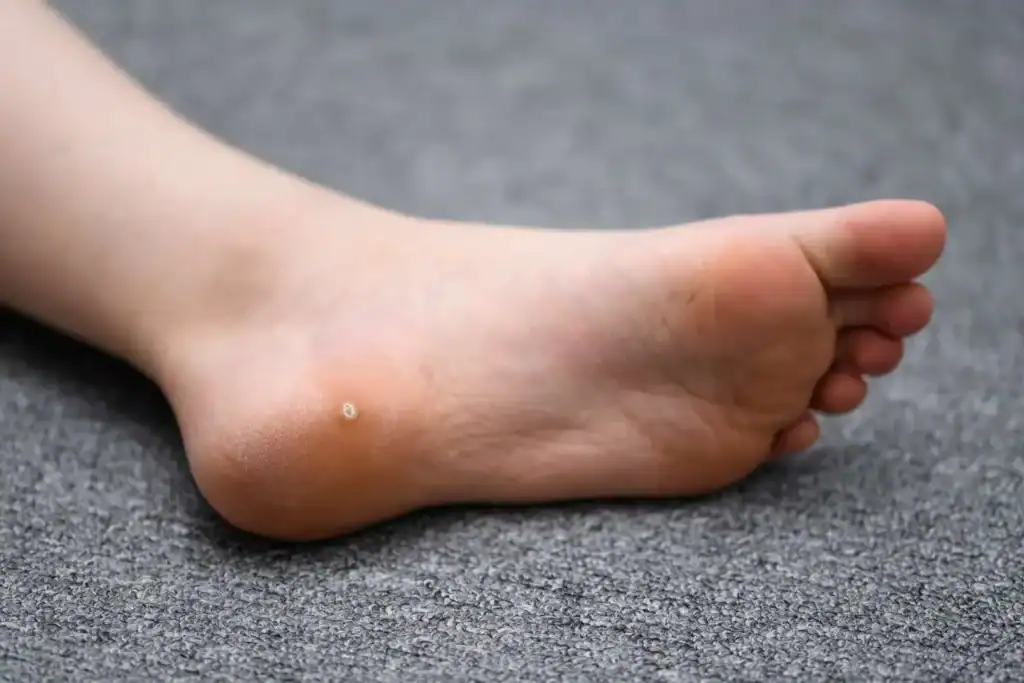 Cryotherapy For Warts And Also Verrucas 2 Image of verruca on the bottom of the foot that able to be treated with Cryotherapy Ashtead