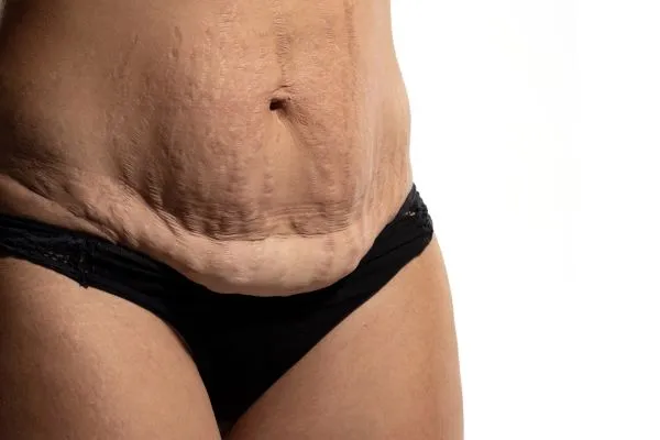The science behind skin tightening Ashtead picture of a woman's sagging skin on the stomach